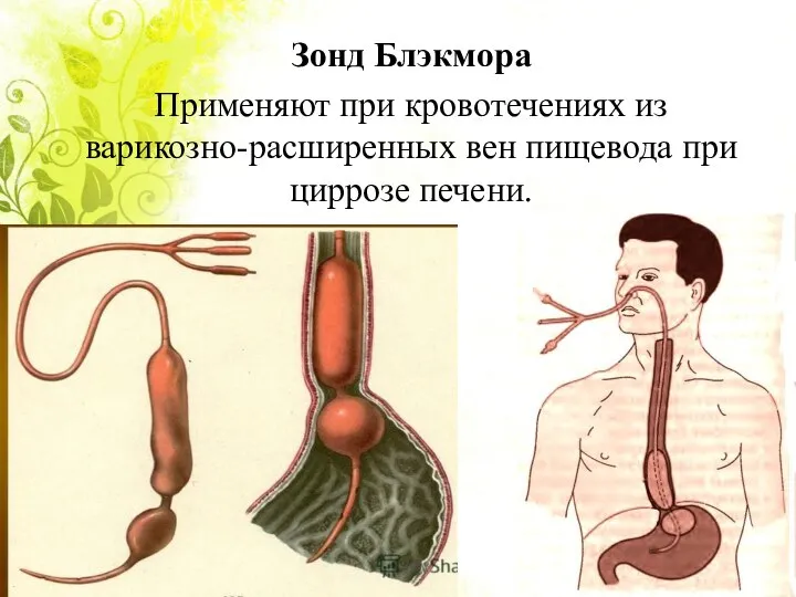 Зонд Блэкмора Применяют при кровотечениях из варикозно-расширенных вен пищевода при циррозе печени.