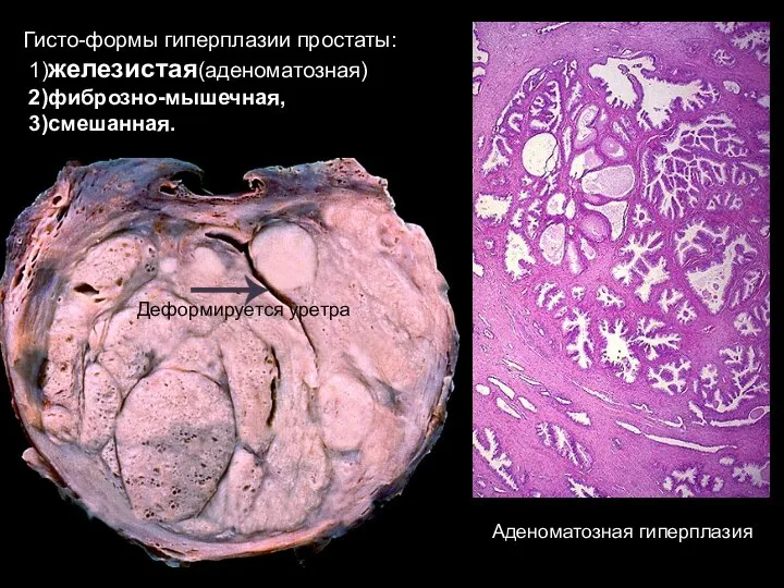 Гисто-формы гиперплазии простаты: 1)железистая(аденоматозная) 2)фиброзно-мышечная, 3)смешанная. Аденоматозная гиперплазия Деформируется уретра