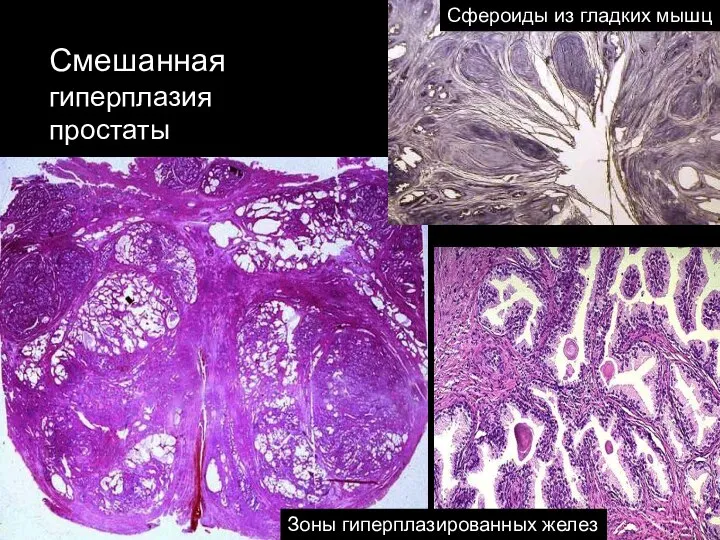 Смешанная гиперплазия простаты Сфероиды из гладких мышц Зоны гиперплазированных желез