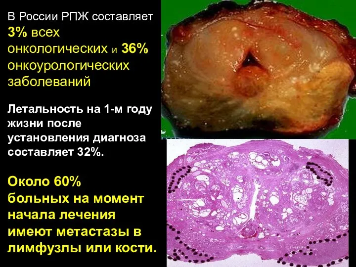 В России РПЖ составляет 3% всех онкологических и 36% онкоурологических заболеваний. Летальность