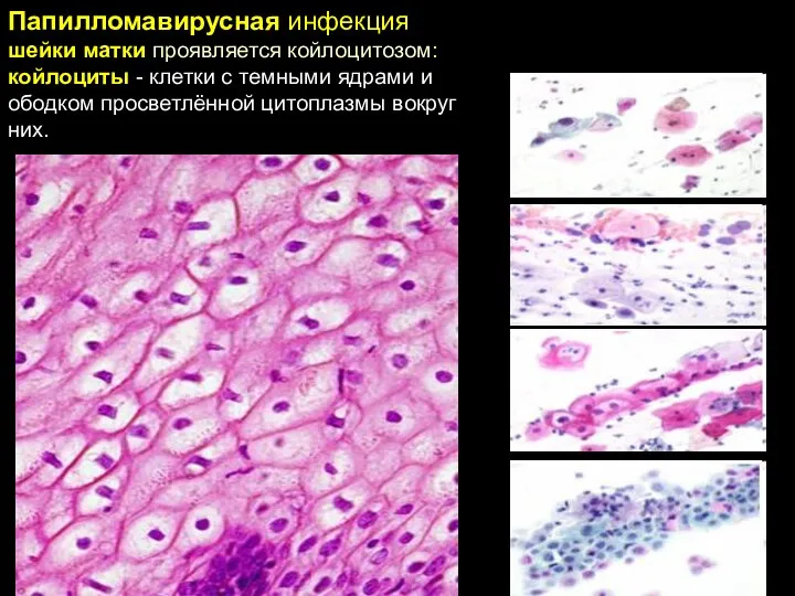 Папилломавирусная инфекция шейки матки проявляется койлоцитозом: койлоциты - клетки с темными ядрами