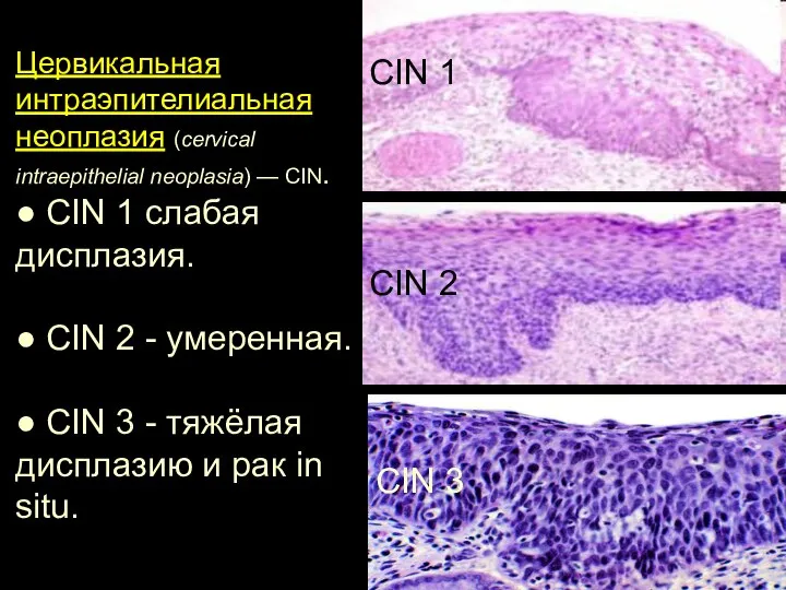 Цервикальная интраэпителиальная неоплазия (cervical intraepithelial neoplasia) — CIN. ● CIN 1 слабая