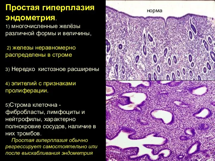 Простая гиперплазия эндометрия. 1) многочисленные желёзы различной формы и величины, 2) железы