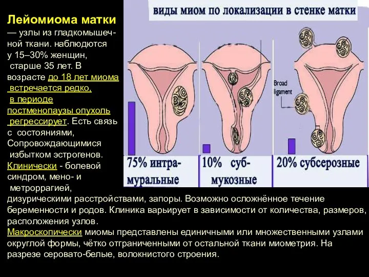 Лейомиома матки — узлы из гладкомышеч- ной ткани. наблюдются у 15–30% женщин,