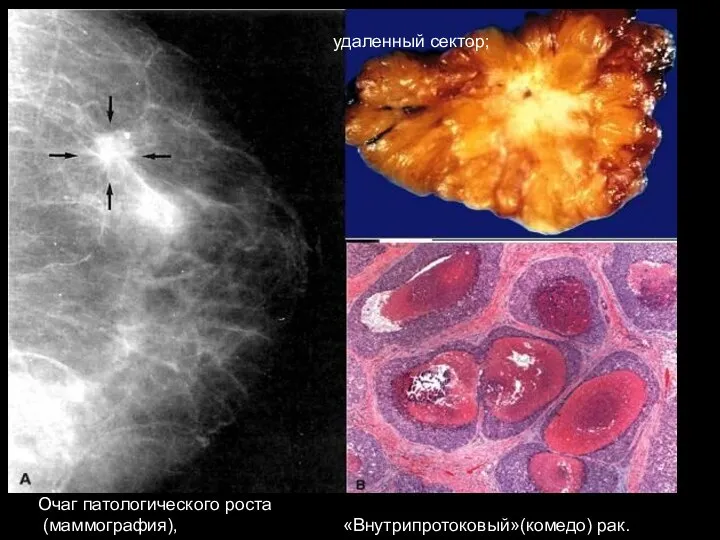 Очаг патологического роста (маммография), «Внутрипротоковый»(комедо) рак. удаленный сектор;