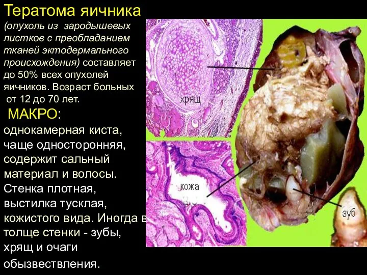 Тератома яичника (опухоль из зародышевых листков с преобладанием тканей эктодермального происхождения) составляет