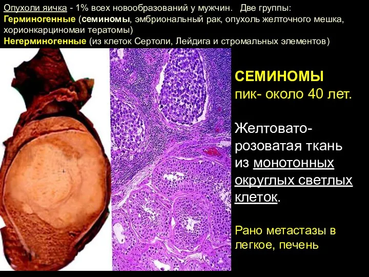 СЕМИНОМЫ пик- около 40 лет. Желтовато-розоватая ткань из монотонных округлых светлых клеток.