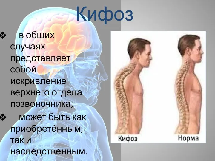 Кифоз в общих случаях представляет собой искривление верхнего отдела позвоночника; может быть