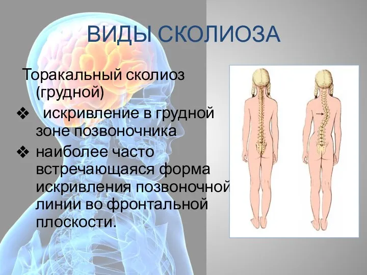 ВИДЫ СКОЛИОЗА Торакальный сколиоз (грудной) искривление в грудной зоне позвоночника наиболее часто