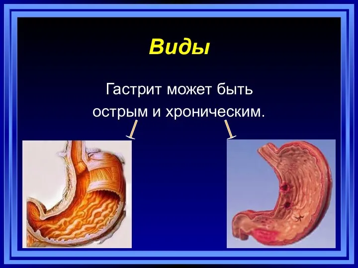 Виды Гастрит может быть острым и хроническим.