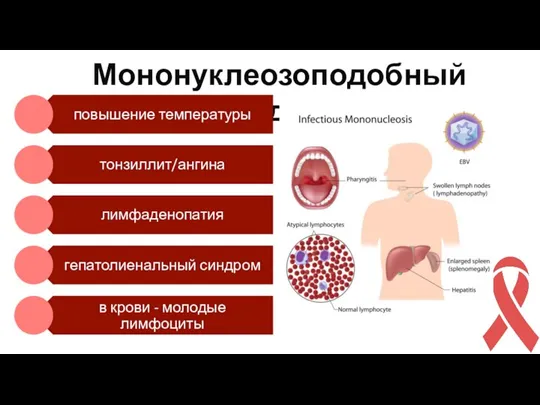 Мононуклеозоподобный синдром