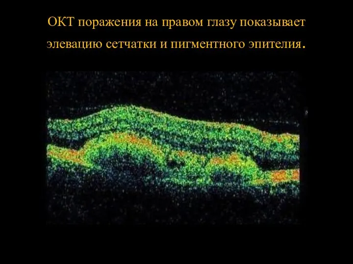 ОКТ поражения на правом глазу показывает элевацию сетчатки и пигментного эпителия.