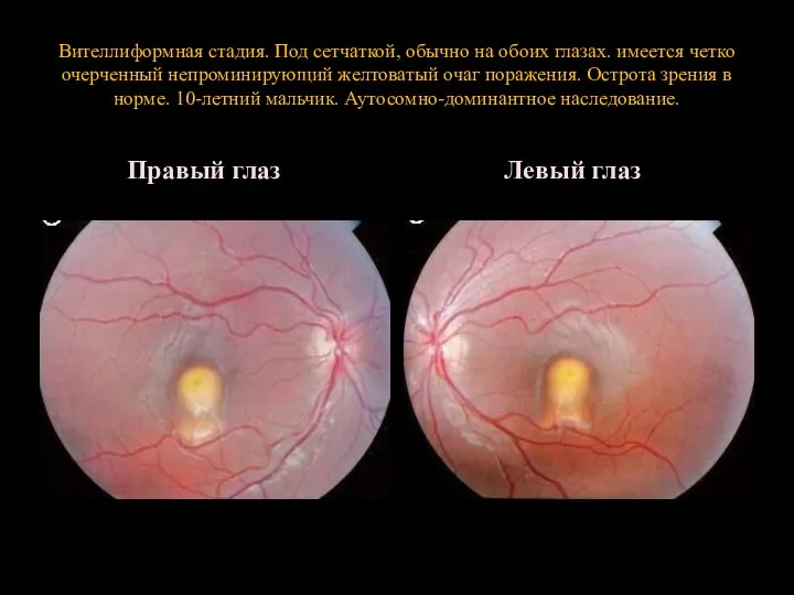 Вителлиформная стадия. Под сетчаткой, обычно на обоих глазах. имеется четко очерченный непроминирующий