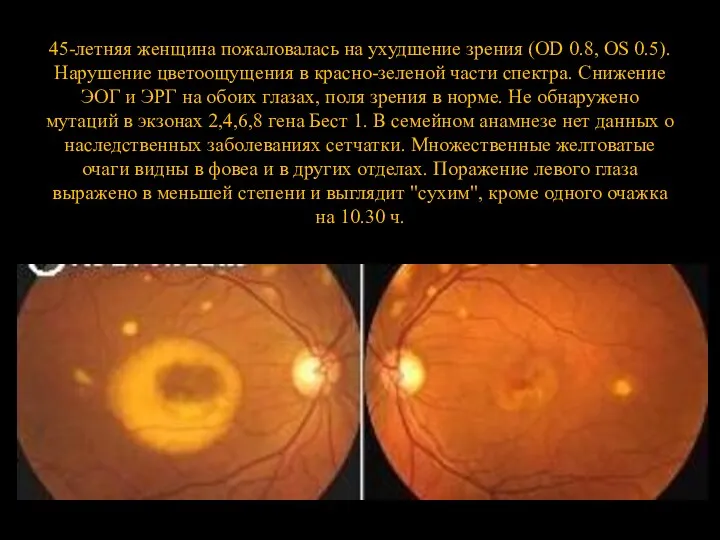 45-летняя женщина пожаловалась на ухудшение зрения (OD 0.8, OS 0.5). Нарушение цветоощущения