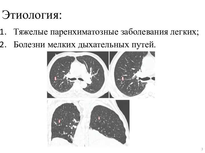 Этиология: Тяжелые паренхиматозные заболевания легких; Болезни мелких дыхательных путей.