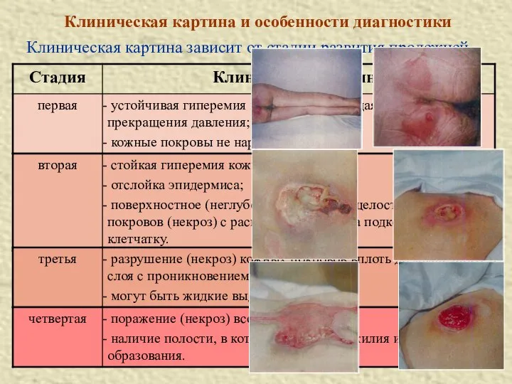 Клиническая картина и особенности диагностики Клиническая картина зависит от стадии развития пролежней.