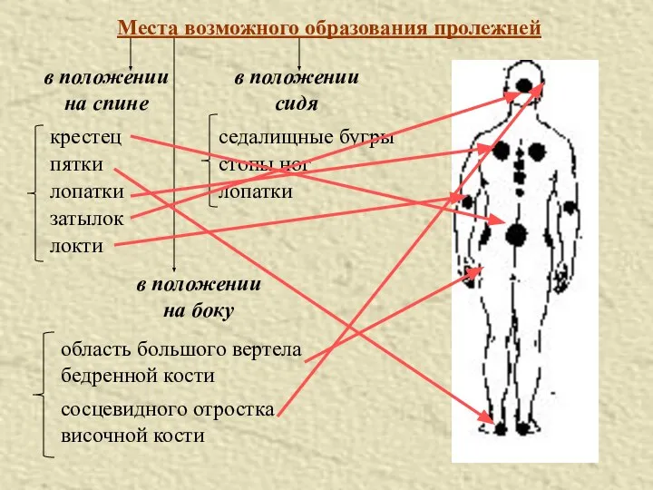 Места возможного образования пролежней в положении на спине в положении сидя в