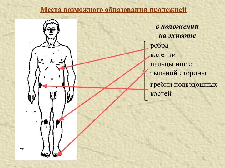 Места возможного образования пролежней в положении на животе ребра коленки пальцы ног