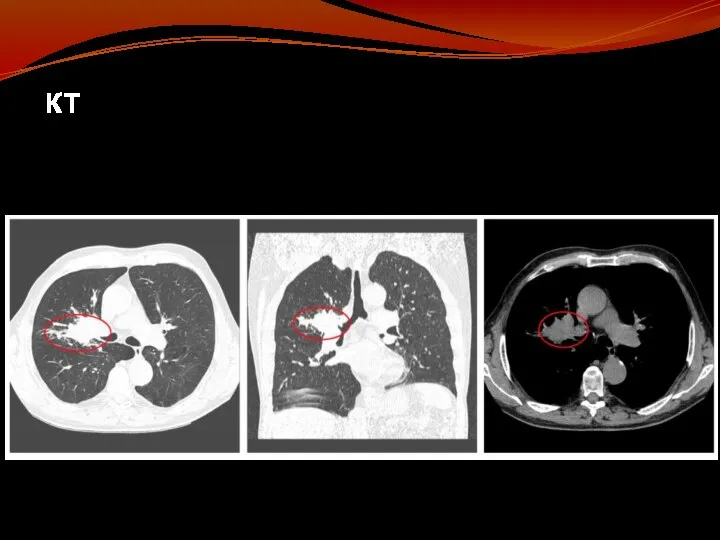 КТ является основной методикой визуализации для оценки патологических изменений, установленных при рентгенографии.