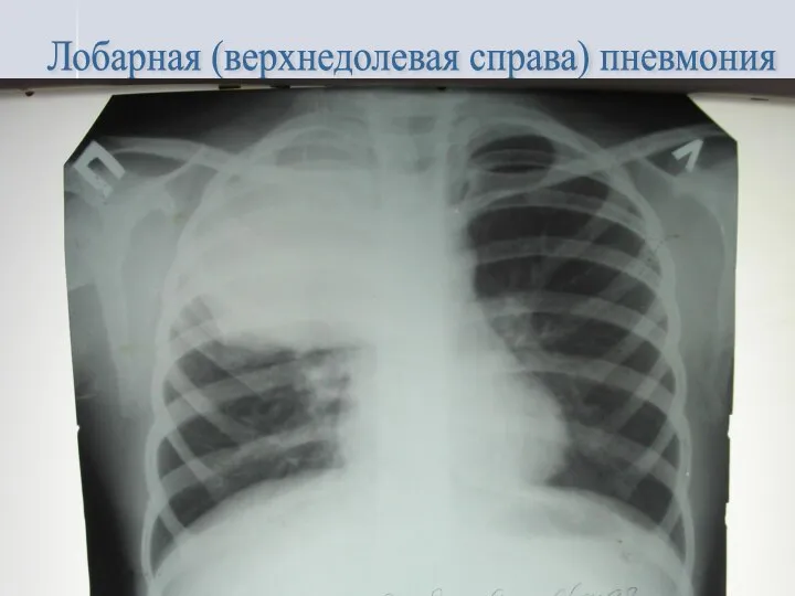 Лобарная (верхнедолевая справа) пневмония