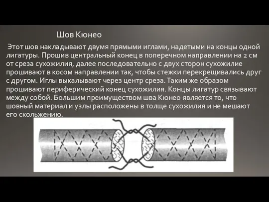 Шов Кюнео Этот шов накладывают двумя прямыми иглами, надетыми на концы одной