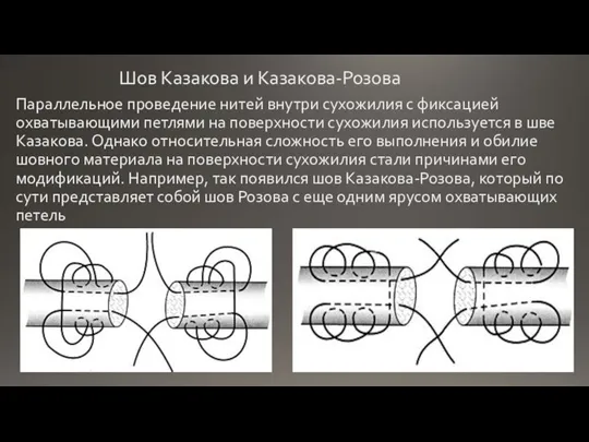 Шов Казакова и Казакова-Розова Параллельное проведение нитей внутри сухожилия с фиксацией охватывающими