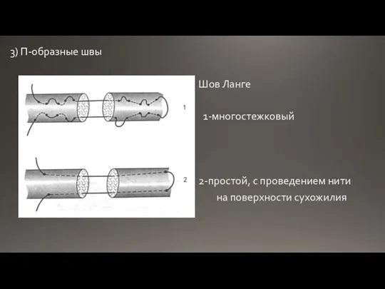 3) П-образные швы Шов Ланге 1-многостежковый 2-простой, с проведением нити на поверхности сухожилия