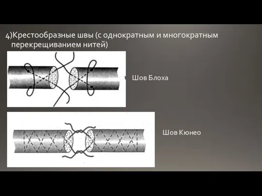 4)Крестообразные швы (с однократным и многократным перекрещиванием нитей) Шов Блоха Шов Кюнео