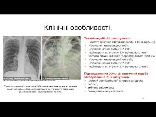 Клінічні особливості: Тяжкий перебіг: ≥1 з наступного: Частота дихання ≥30/хв (дорослі); ≥40/хв