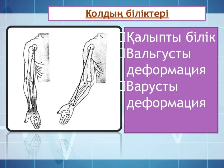 Қолдың біліктері Қалыпты білік Вальгусты деформация Варусты деформация