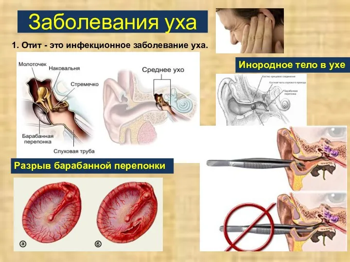 Заболевания уха 1. Отит - это инфекционное заболевание уха. Разрыв барабанной перепонки Инородное тело в ухе