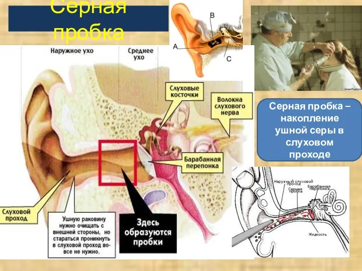 Серная пробка Серная пробка – накопление ушной серы в слуховом проходе