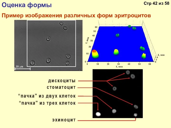 Пример изображения различных форм эритроцитов Оценка формы