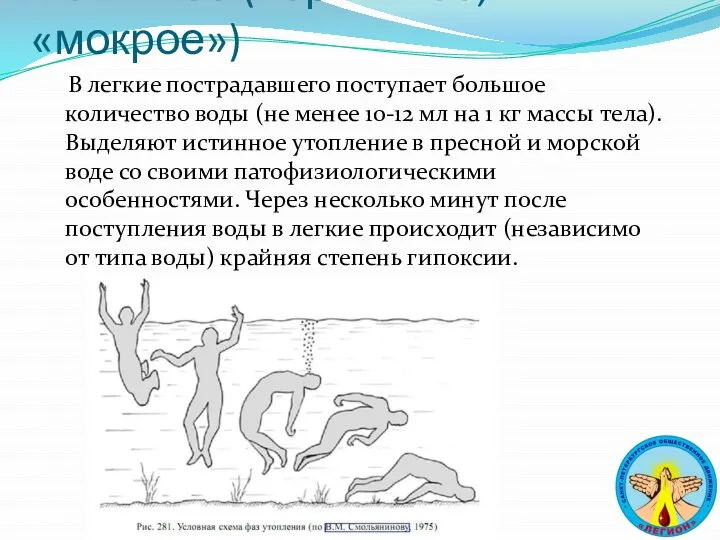 Истинное (первичное, «мокрое») В легкие пострадавшего поступает большое количество воды (не менее