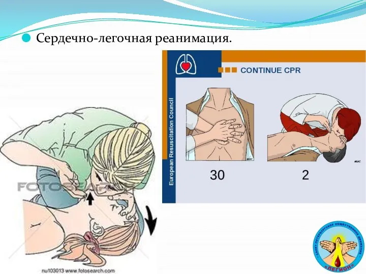 Сердечно-легочная реанимация.