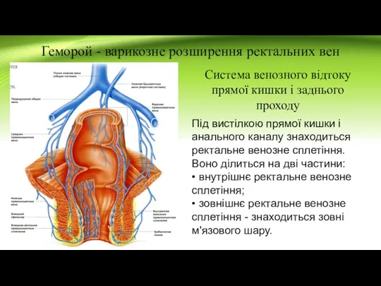 Геморой - варикозне розширення ректальних вен Система венозного відтоку прямої кишки і