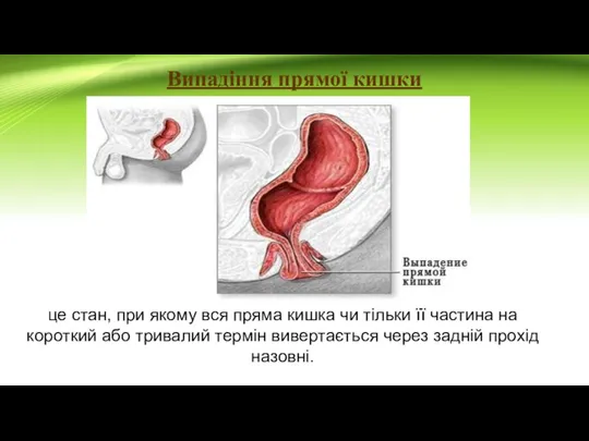 Випадіння прямої кишки це стан, при якому вся пряма кишка чи тільки