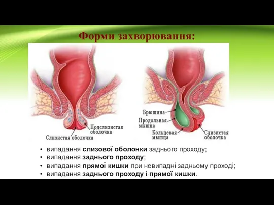 Форми захворювання: випадання слизової оболонки заднього проходу; випадання заднього проходу; випадання прямої