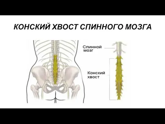 КОНСКИЙ ХВОСТ СПИННОГО МОЗГА