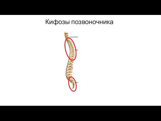 Кифозы позвоночника