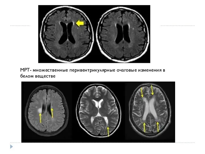 МРТ- множественные перивентрикулярные очаговые изменения в белом веществе