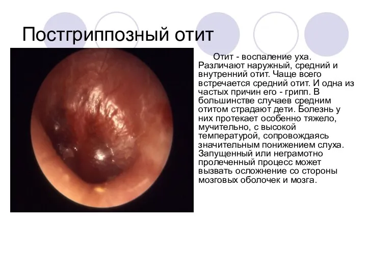 Постгриппозный отит Отит - воспаление уха. Различают наружный, средний и внутренний отит.