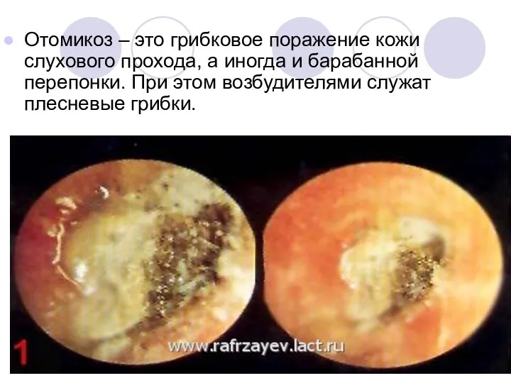 Отомикоз – это грибковое поражение кожи слухового прохода, а иногда и барабанной