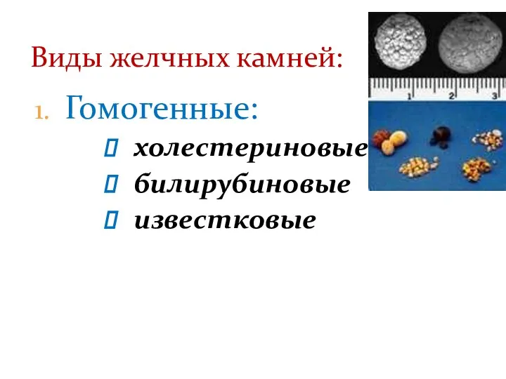 Гомогенные: холестериновые билирубиновые известковые Виды желчных камней: