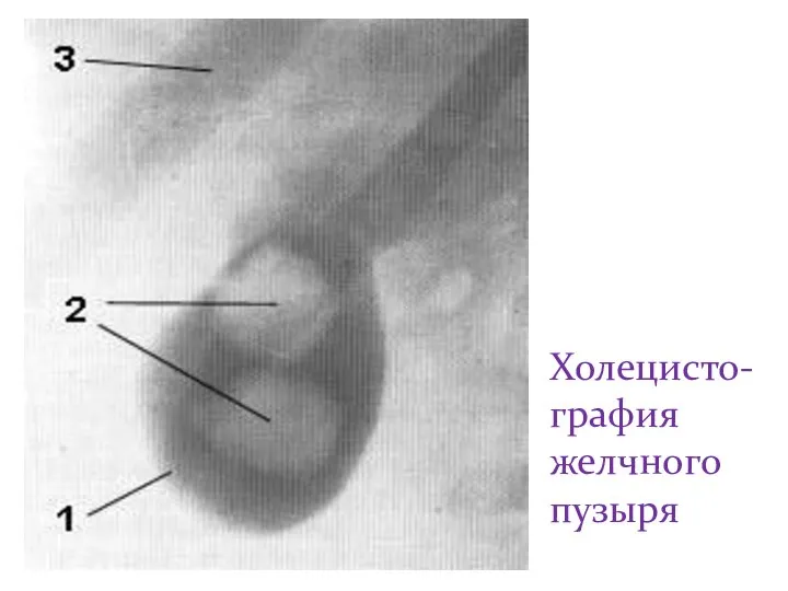 Холецисто-графия желчного пузыря