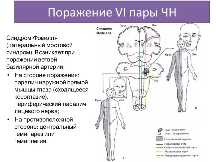 Синдром Фовилля (латеральный мостовой синдром). Возникает при поражении ветвей базилярной артерии. На