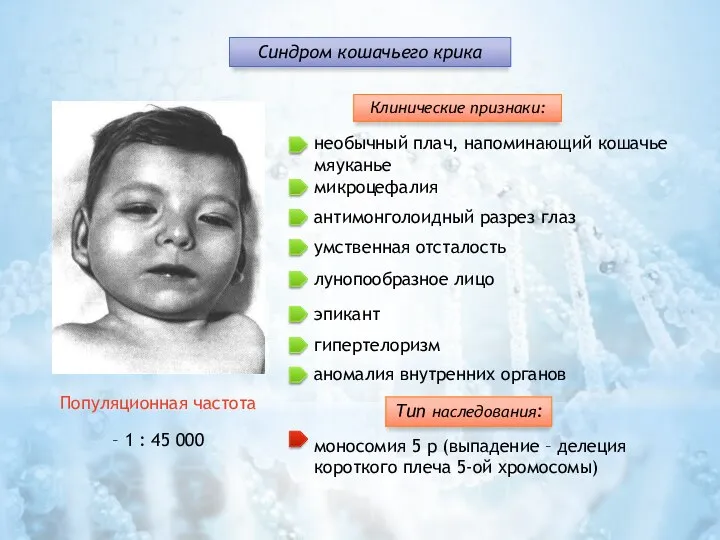 Клинические признаки: микроцефалия антимонголоидный разрез глаз умственная отсталость лунопообразное лицо эпикант гипертелоризм