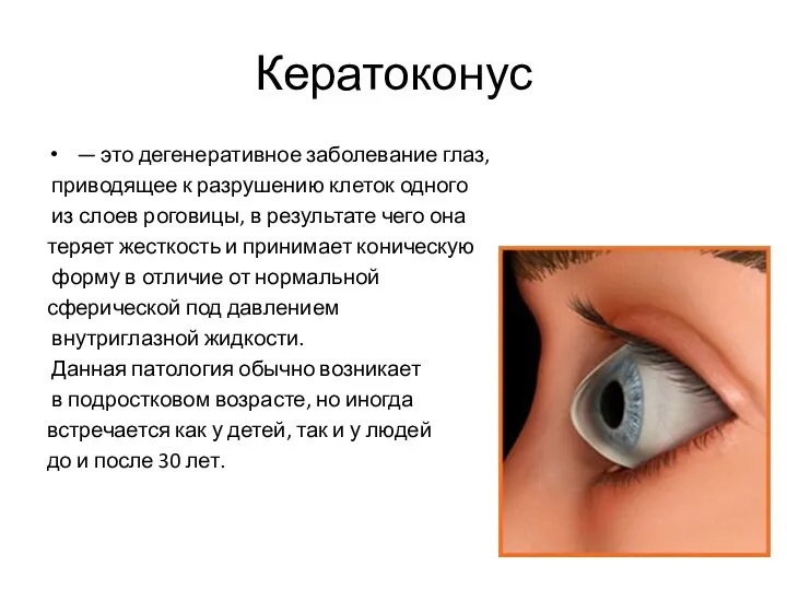 Кератоконус — это дегенеративное заболевание глаз, приводящее к разрушению клеток одного из