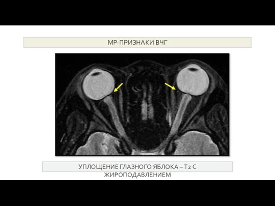 МР-признаки ВЧГ УПЛОЩЕНИЕ ГЛАЗНОГО ЯБЛОКА – T2 С ЖИРОПОДАВЛЕНИЕМ МР-ПРИЗНАКИ ВЧГ