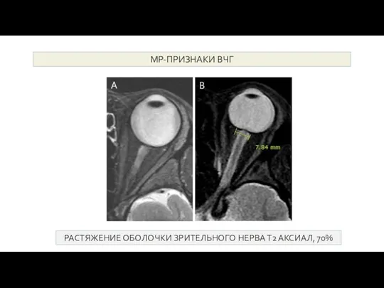 МР-признаки ВЧГ РАСТЯЖЕНИЕ ОБОЛОЧКИ ЗРИТЕЛЬНОГО НЕРВА Т2 АКСИАЛ, 70% МР-ПРИЗНАКИ ВЧГ